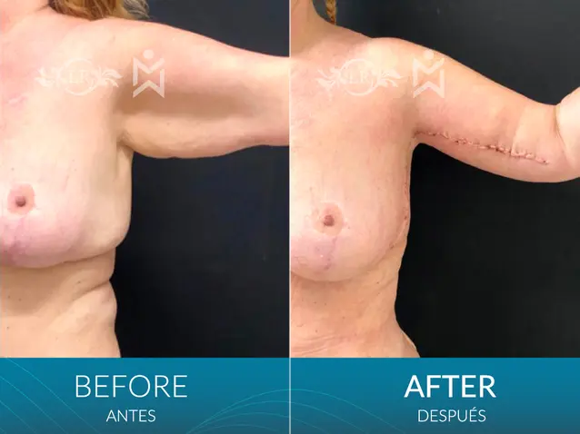 Arm-lift-plus-L-shaped-Brawline-lift-(extended-arm-lift)-and-360-lipo Arm-lift-plus-L-shaped-Brawline-lift-(extended-arm-lift)-and-360-lipo