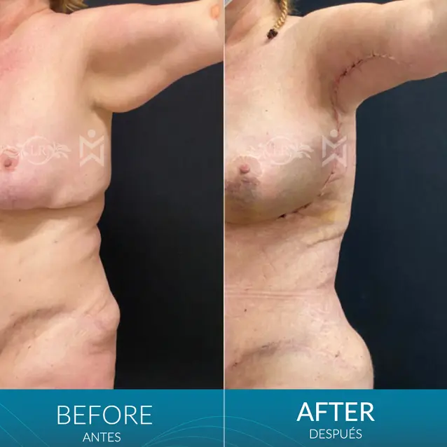 Arm-lift-plus-L-shaped-Brawline-lift-(extended-arm-lift)-and-360-lipo Arm-lift-plus-L-shaped-Brawline-lift-(extended-arm-lift)-and-360-lipo