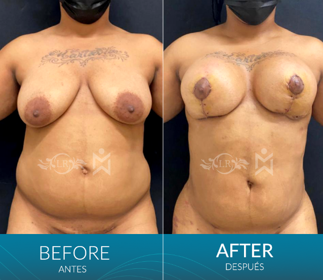 Breast-lift-with-implants-plus-lipo