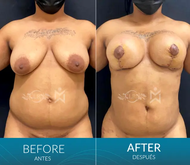 Breast-lift-with-implants-plus-lipo Breast-lift-with-implants-plus-lipo