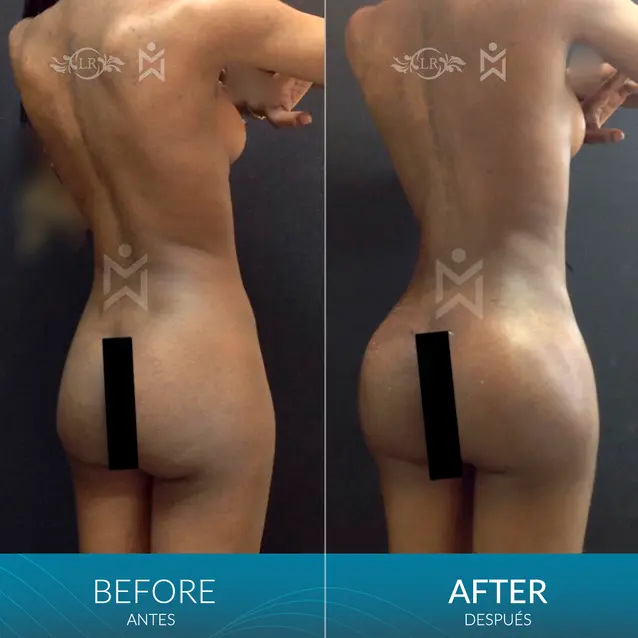 Butt-Implants,-Lipo-and-BBL-(hips) Butt-Implants,-Lipo-and-BBL-(hips)