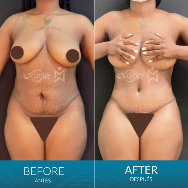 Tt-360-lipo Tt-360-lipo