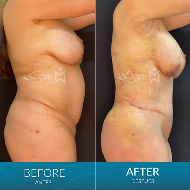 Tt-revision-with-muscle-repair Tt-revision-with-muscle-repair