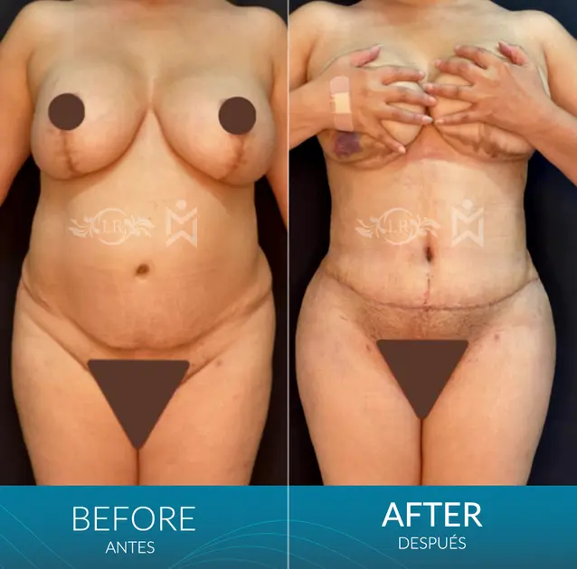 Tt-revisión-with-muscle-repair Tt-revisión-with-muscle-repair