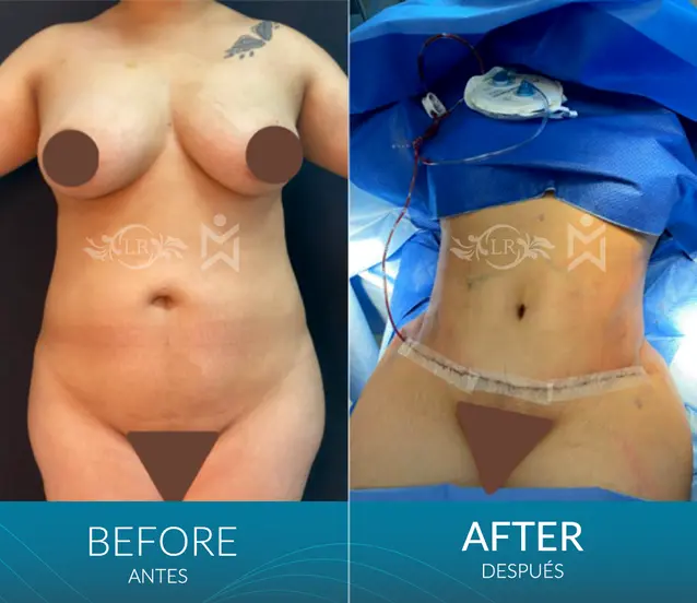 Tummy-tuck-lipo Tummy-tuck-lipo